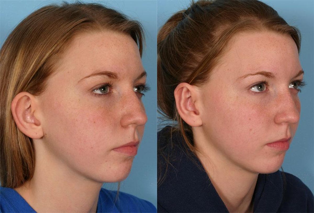 Ear Surgery (Otoplasty) Before & After Gallery - Patient 260357 - Image 2