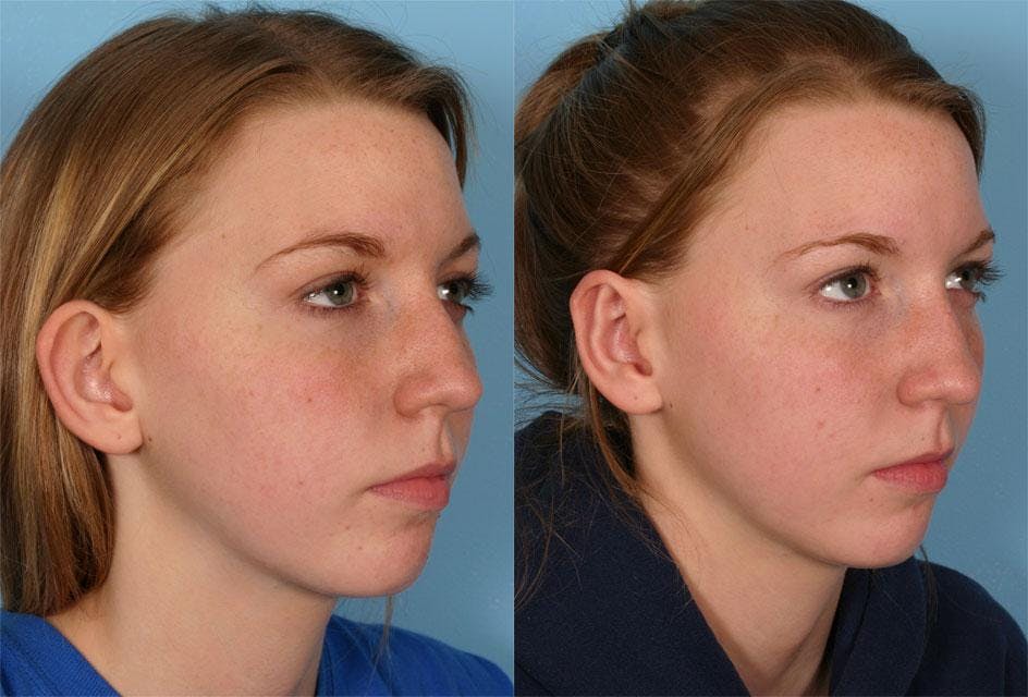 Ear Surgery (Otoplasty) Before & After Gallery - Patient 260357 - Image 2