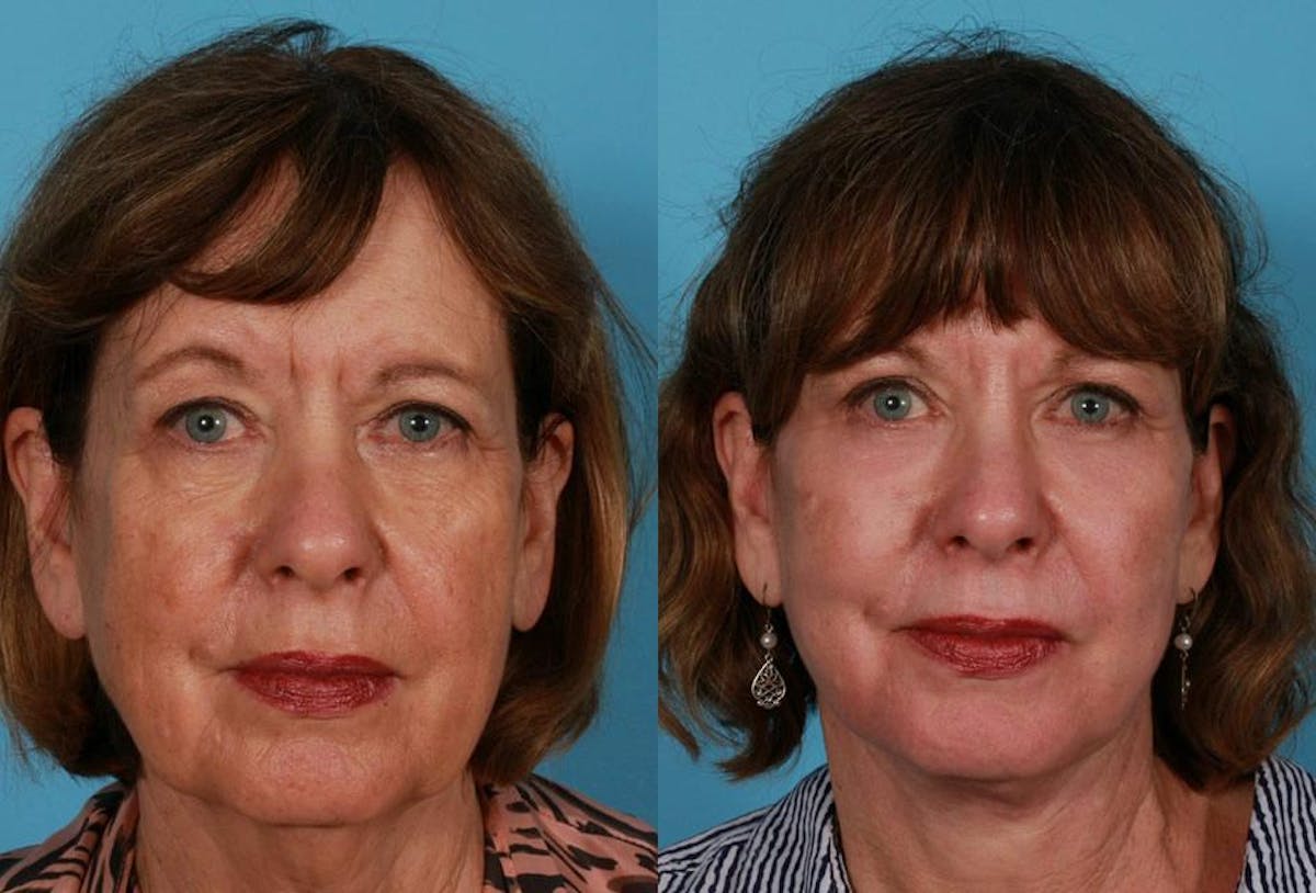 Eyelid Surgery (Blepharoplasty) Before & After Gallery - Patient 409041 - Image 1