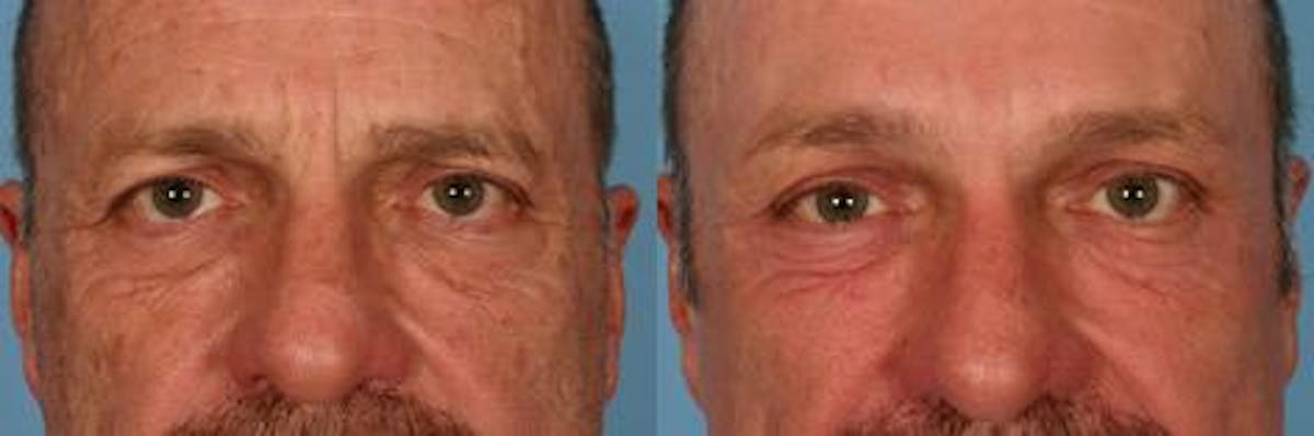 Endoscoplic Browlift Before & After Gallery - Patient 823519 - Image 4