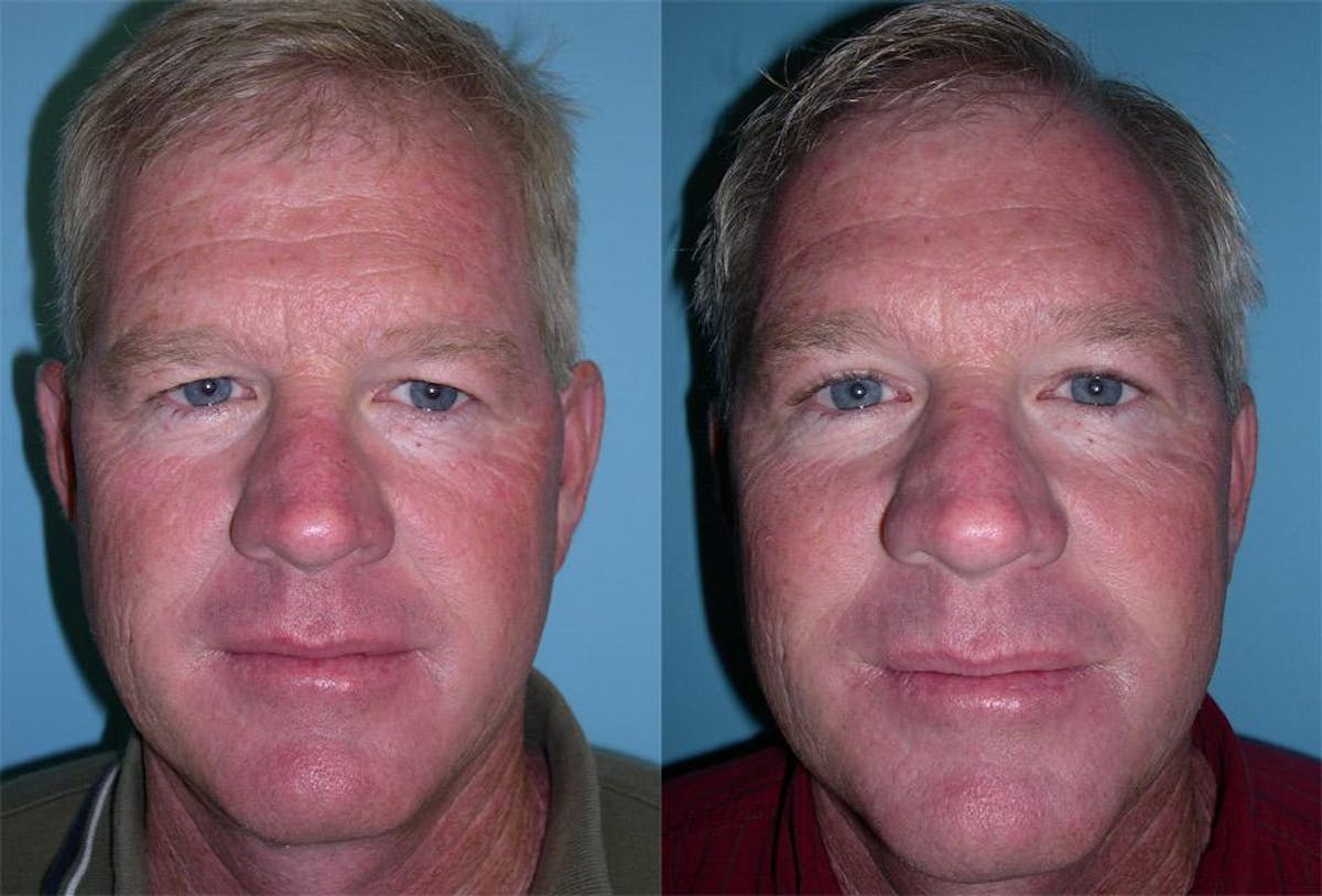 Endoscoplic Browlift Before & After Gallery - Patient 224152 - Image 1
