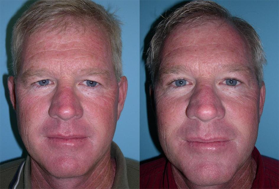 Endoscopic Brow Lift Before & After Gallery - Patient 224152 - Image 1