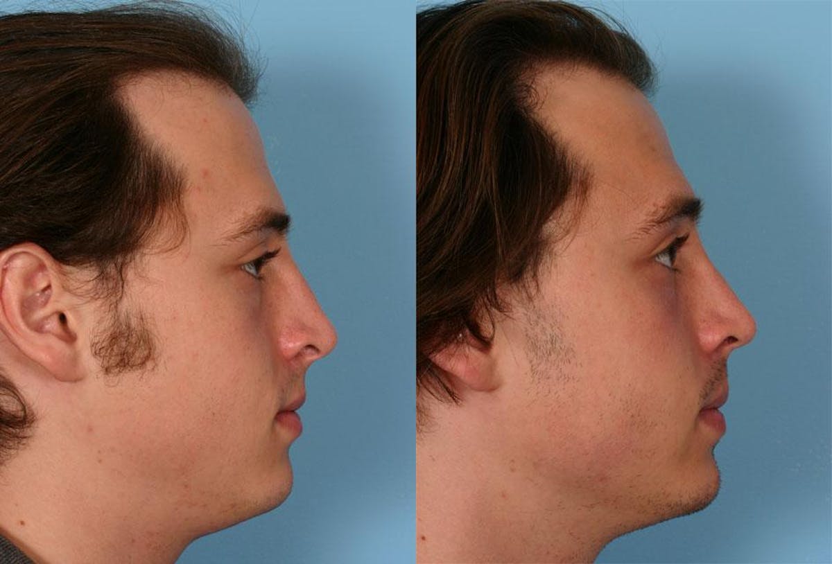 Nasal Obstruction Before & After Gallery - Patient 495408 - Image 2