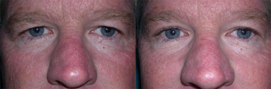 Endoscopic Brow Lift Before & After Gallery - Patient 224152 - Image 2