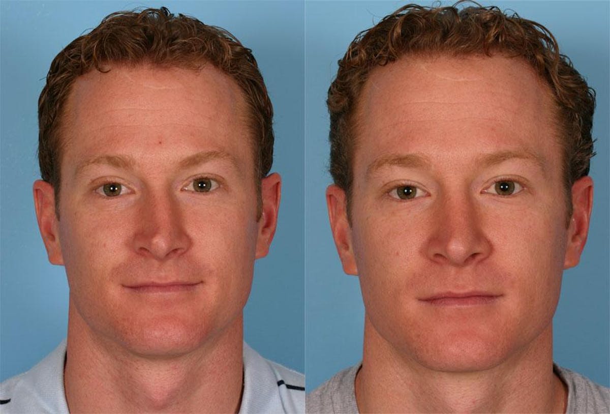 Rhinoplasty Before & After Gallery - Patient 249063 - Image 1