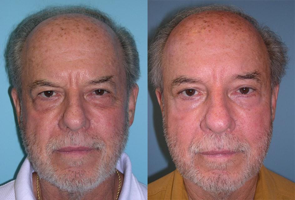 Endoscopic Brow Lift Before & After Gallery - Patient 619864 - Image 1