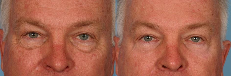 Eyelid Surgery (Blepharoplasty) Before & After Gallery - Patient 214588 - Image 2