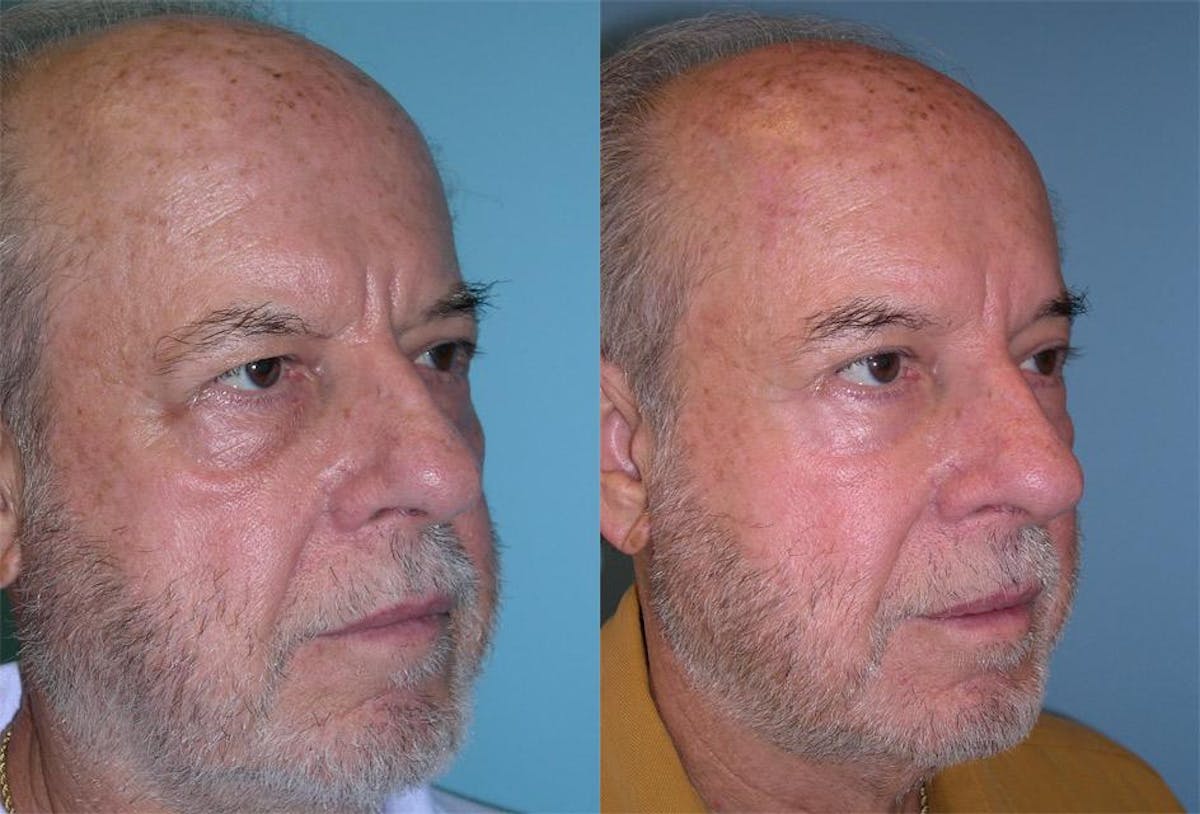 Endoscoplic Browlift Before & After Gallery - Patient 619864 - Image 2