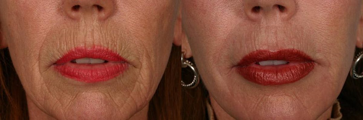 Limited Incision Facelift Before & After Gallery - Patient 336028 - Image 4