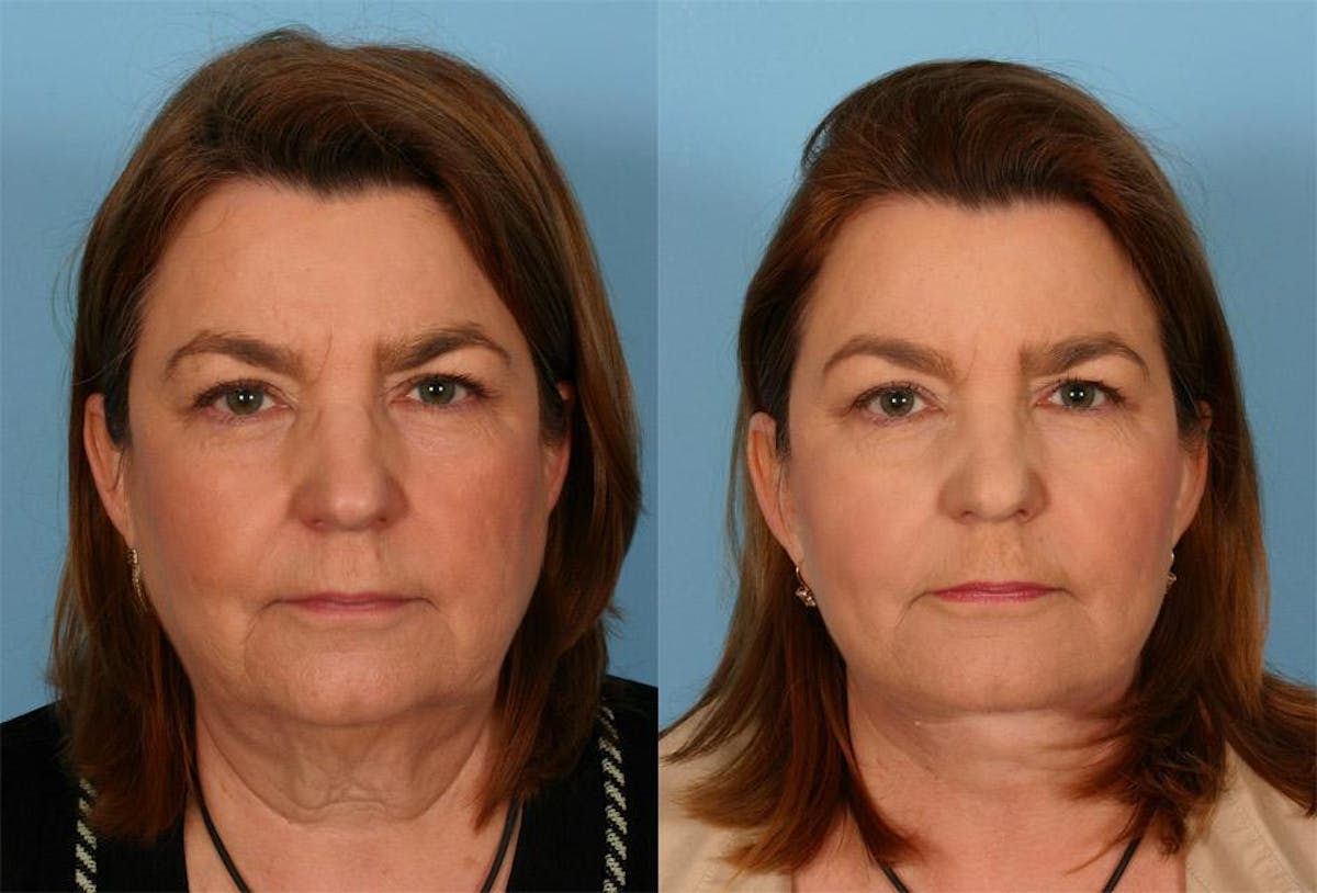 Facelift Before & After Gallery - Patient 169490 - Image 1