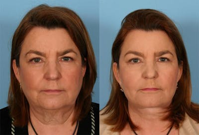 Facelift Before & After Gallery - Patient 169490 - Image 1