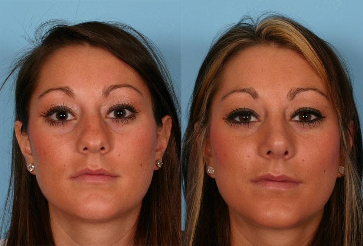 Nasal Obstruction Before & After Gallery - Patient 317462 - Image 1