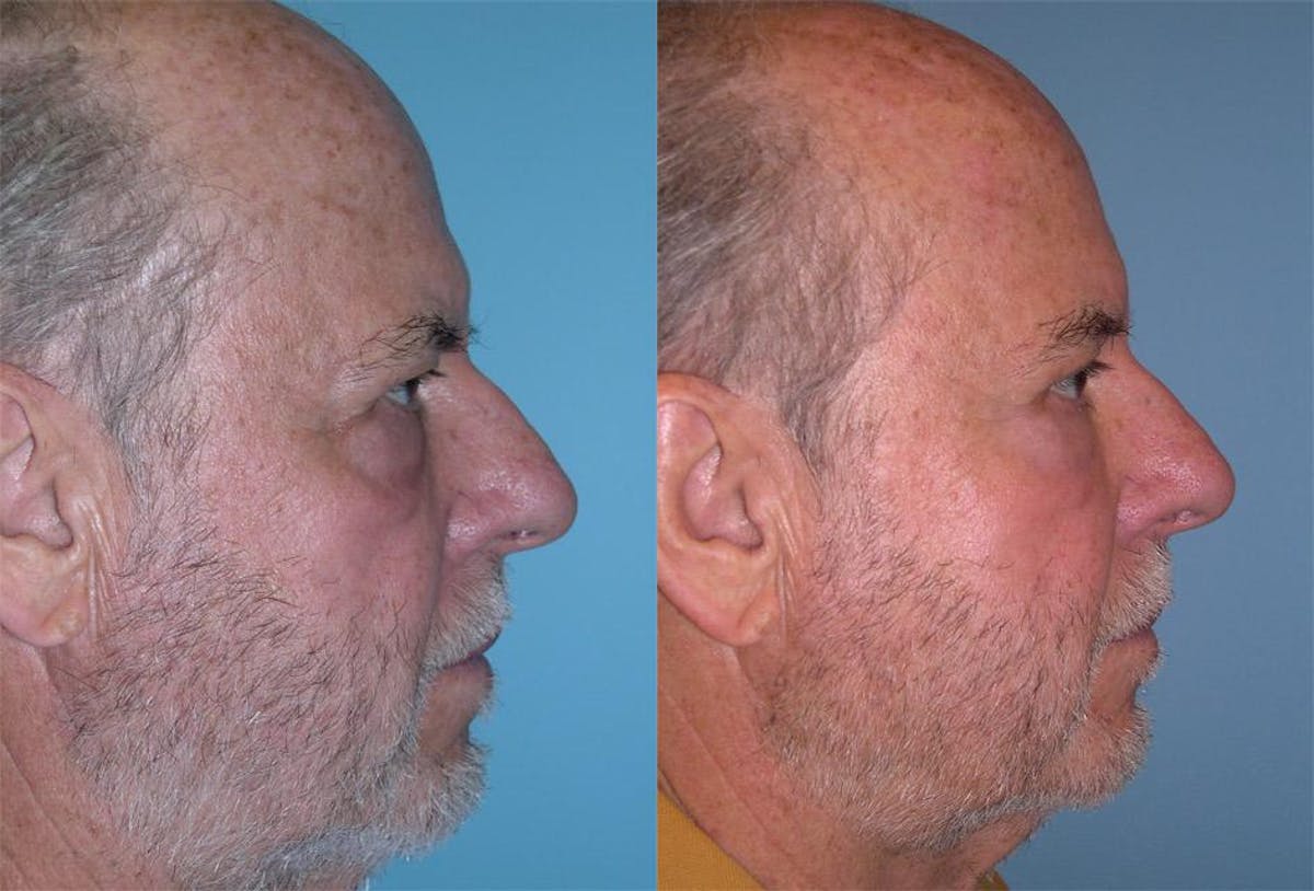 Endoscoplic Browlift Before & After Gallery - Patient 619864 - Image 3