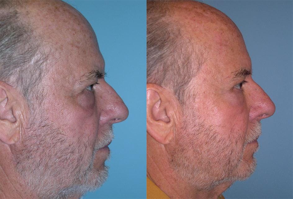 Endoscopic Brow Lift Before & After Gallery - Patient 619864 - Image 3