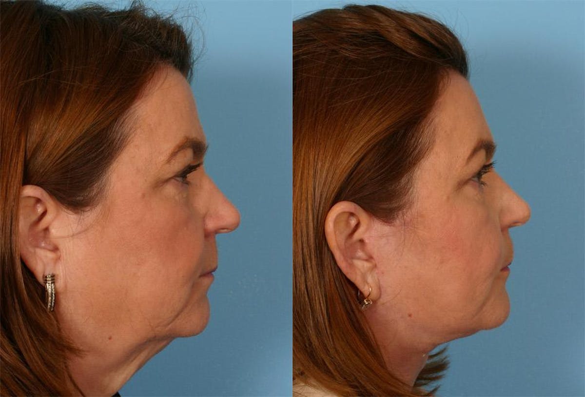 Facelift Before & After Gallery - Patient 169490 - Image 2