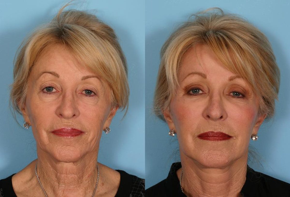 Limited Incision Facelift Before & After Gallery - Patient 113129 - Image 1