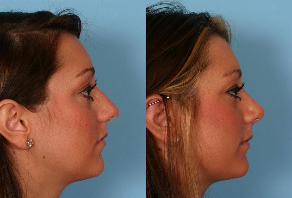 Nasal Obstruction Before & After Gallery - Patient 317462 - Image 2