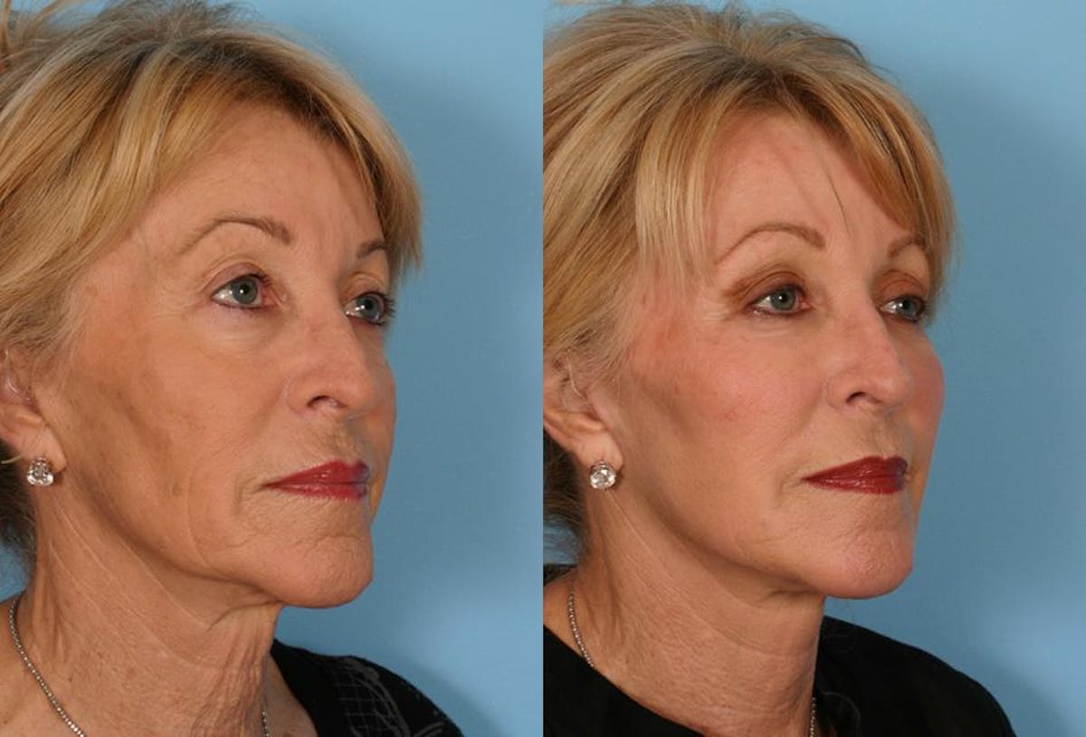 Limited Incision Facelift Before & After Gallery - Patient 113129 - Image 2