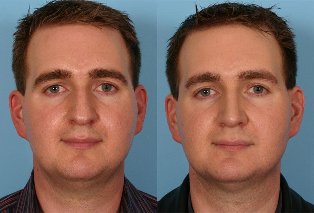 Rhinoplasty Before & After Gallery - Patient 284627 - Image 1