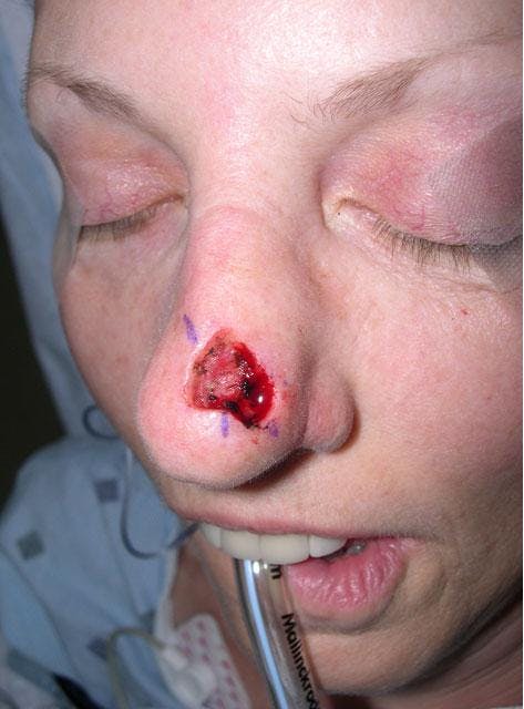 Skin Cancer Before & After Gallery - Patient 251481 - Image 4