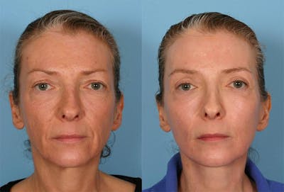 Facelift Before & After Gallery - Patient 280013 - Image 1