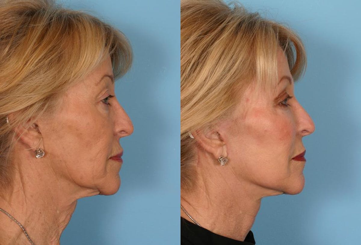 Limited Incision Facelift Before & After Gallery - Patient 113129 - Image 3