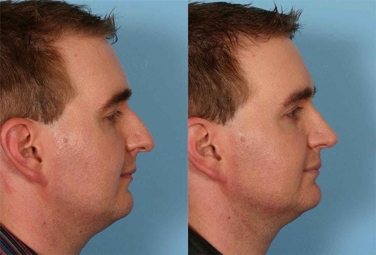 Rhinoplasty Before & After Gallery - Patient 284627 - Image 2