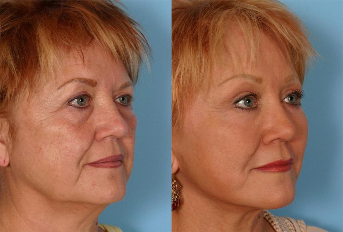 Facial Fat Transfer Before & After Gallery - Patient 403894 - Image 2