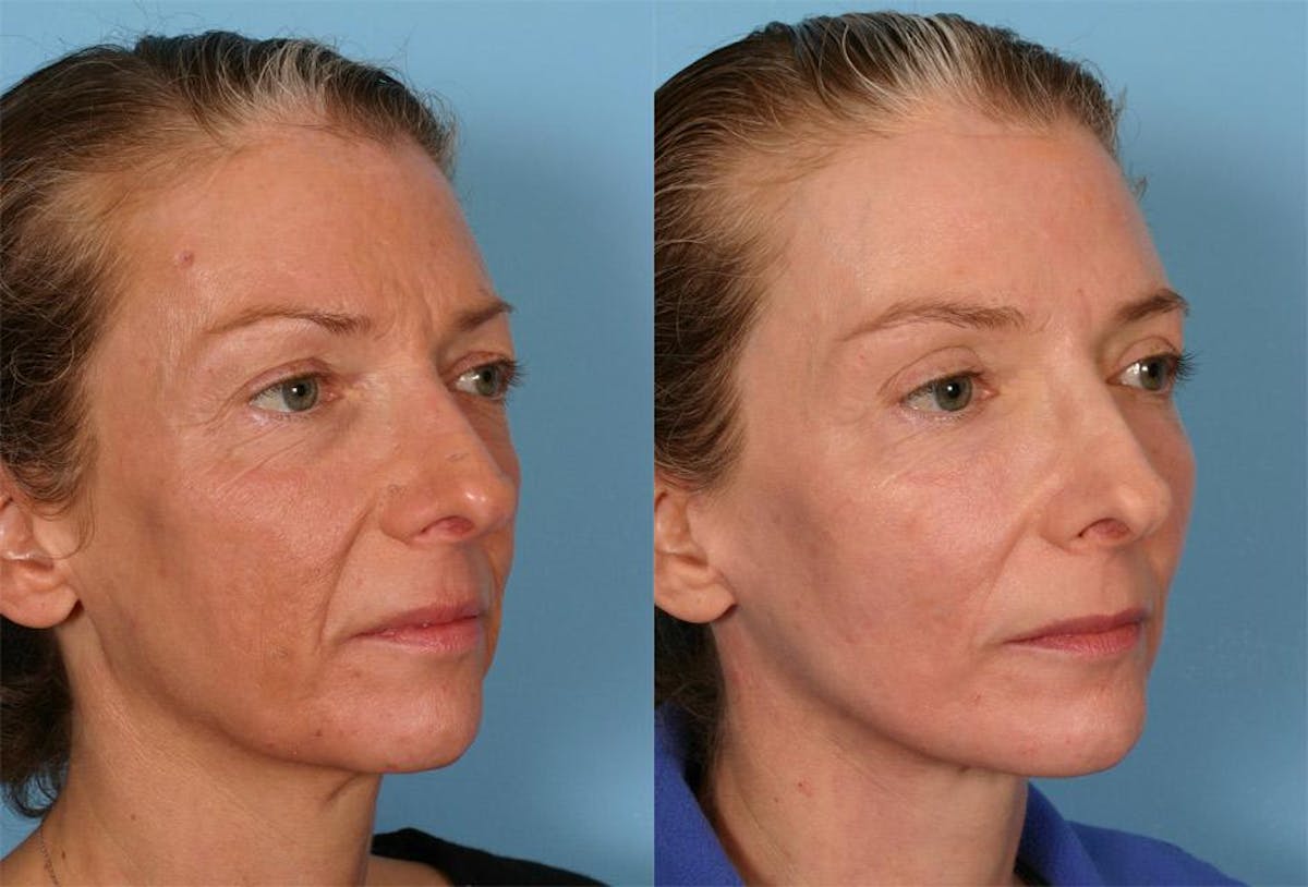 Facelift Before & After Gallery - Patient 280013 - Image 2