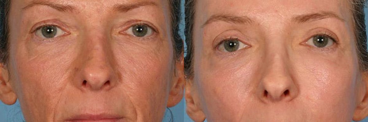 Eyelid Surgery (Blepharoplasty) Before & After Gallery - Patient 376994 - Image 3