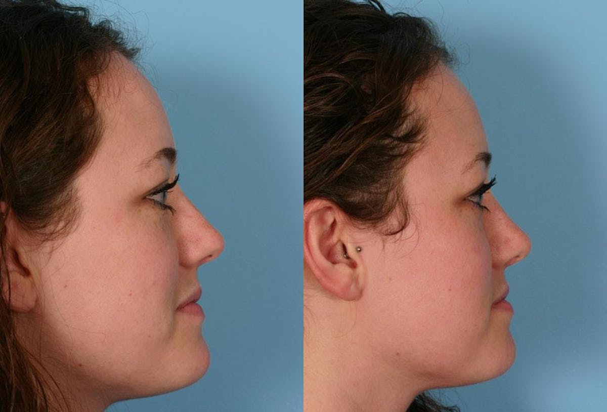 Nasal Obstruction Before & After Gallery - Patient 354688 - Image 2