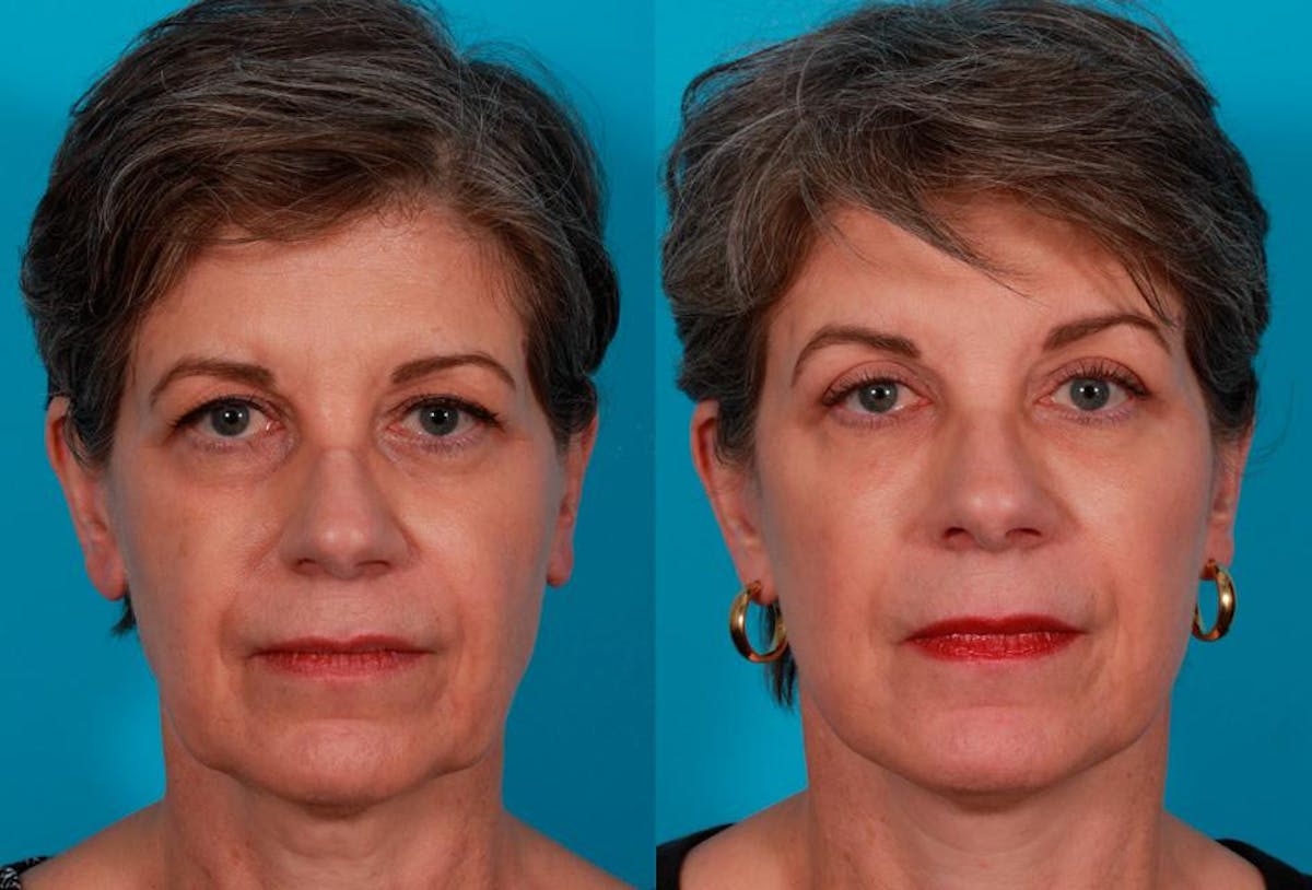 Limited Incision Facelift Before & After Gallery - Patient 255774 - Image 1