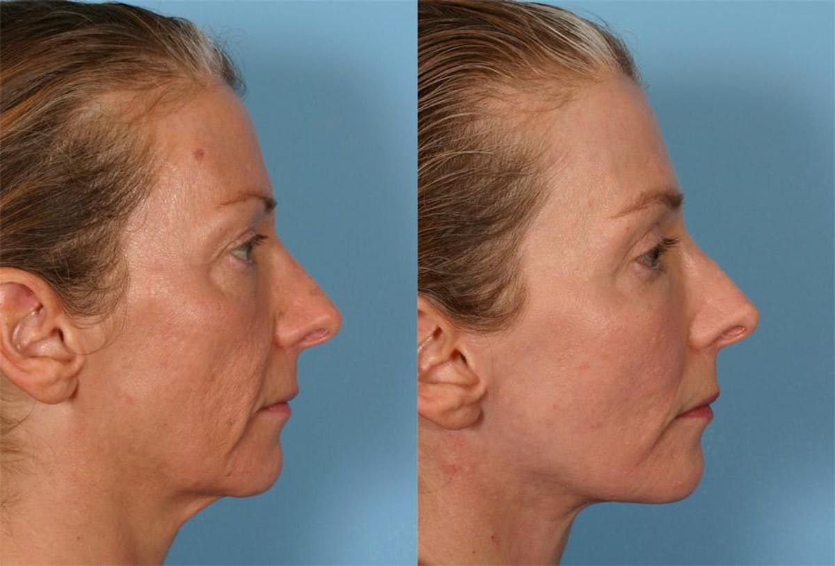 Facelift Before & After Gallery - Patient 280013 - Image 3