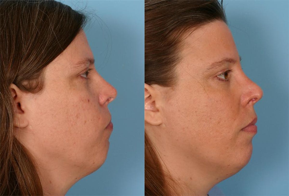 Skin Cancer Before & After Gallery - Patient 425246 - Image 2