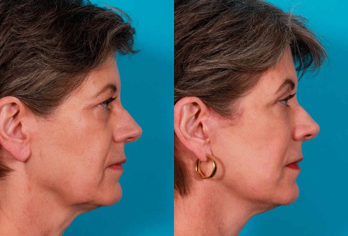 Limited Incision Facelift Before & After Gallery - Patient 255774 - Image 2