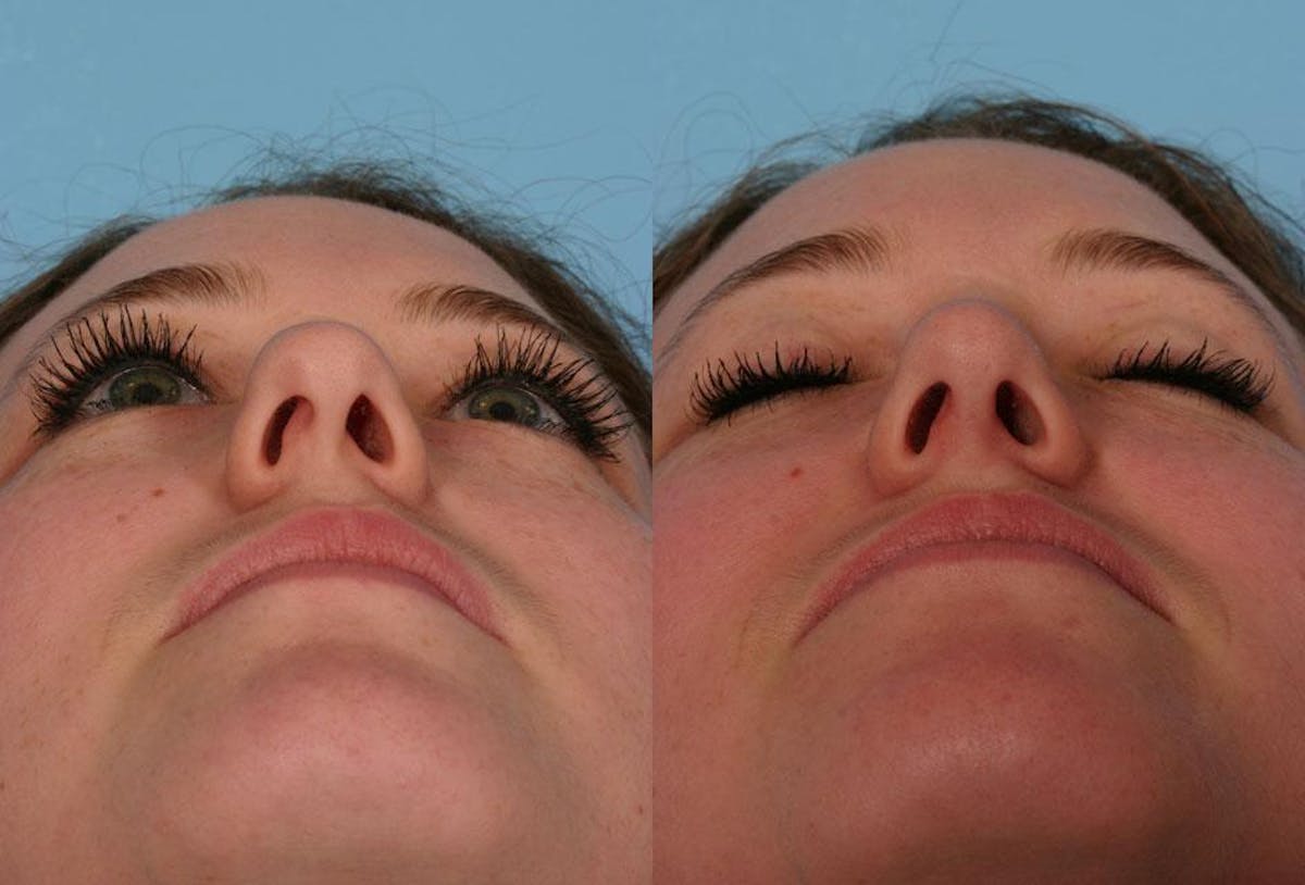 Nasal Obstruction Before & After Gallery - Patient 354688 - Image 3