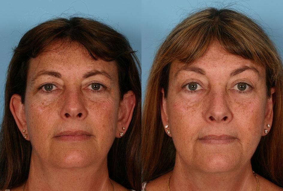 Endoscopic Brow Lift Before & After Gallery - Patient 165157 - Image 1