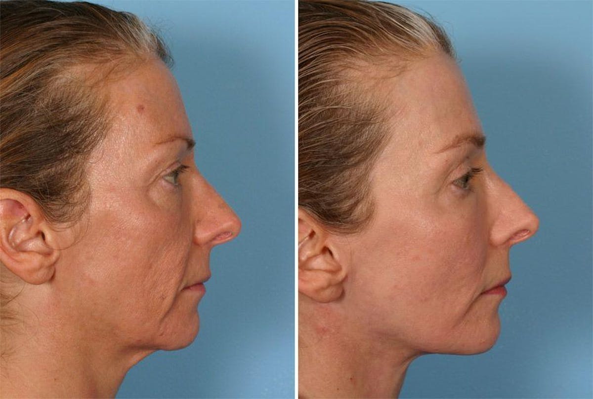 Eyelid Surgery (Blepharoplasty) Before & After Gallery - Patient 376994 - Image 5