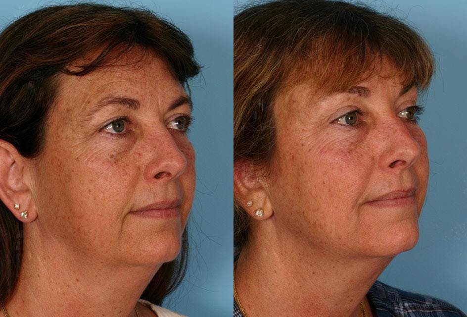 Endoscopic Brow Lift Before & After Gallery - Patient 165157 - Image 2