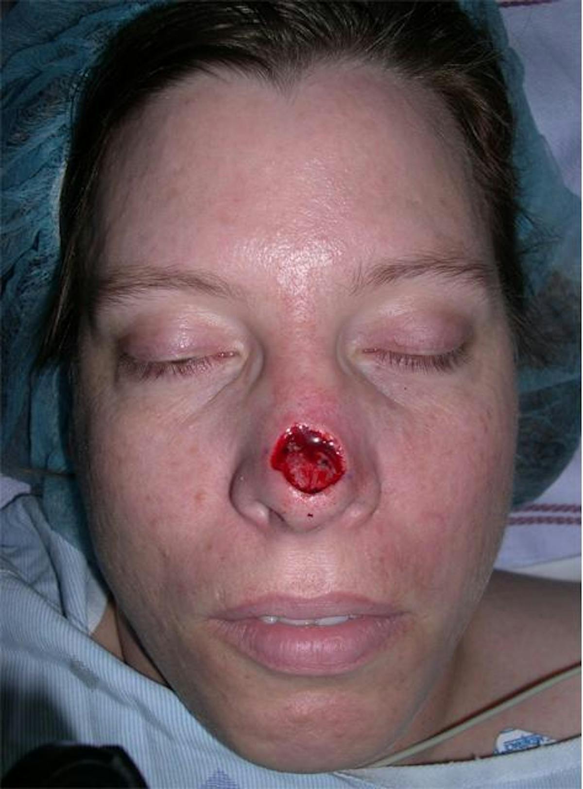 Skin Cancer Before & After Gallery - Patient 425246 - Image 3