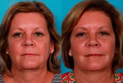Limited Incision Facelift Before & After Gallery - Patient 221496 - Image 1