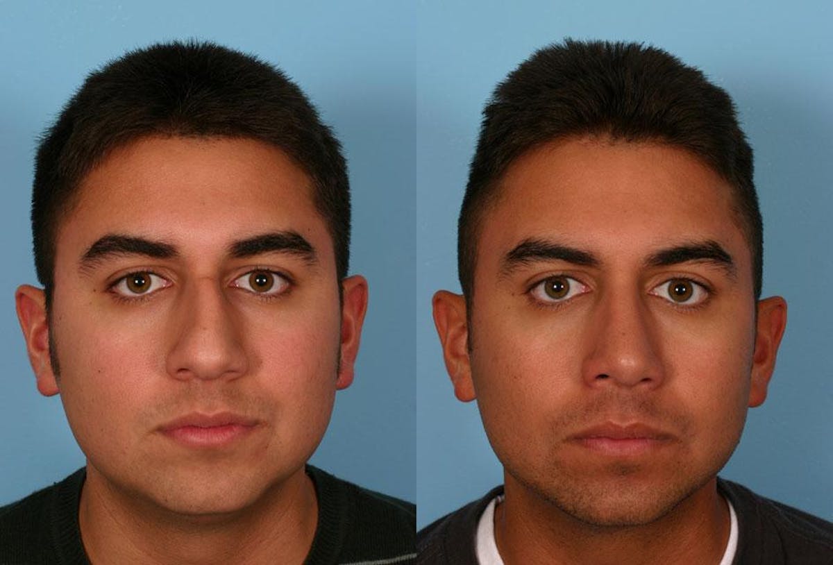 Nasal Obstruction Before & After Gallery - Patient 151758 - Image 1