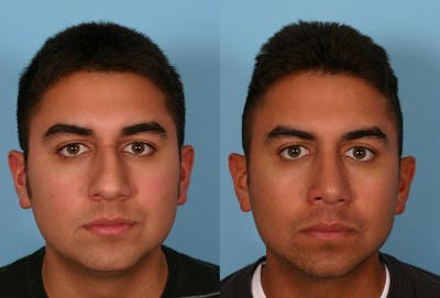 Nasal Obstruction Before & After Gallery - Patient 151758 - Image 1