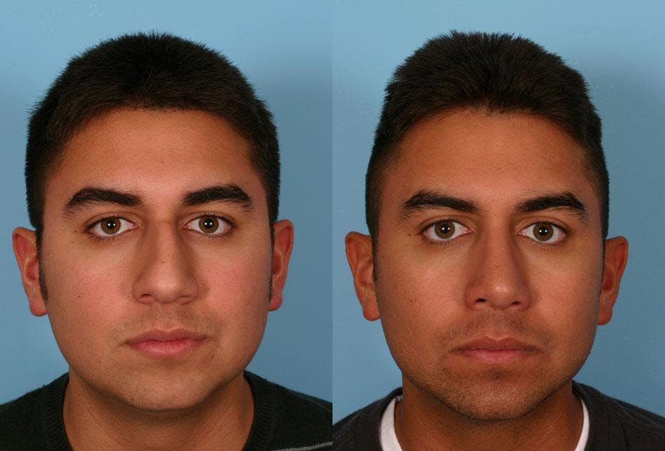 Nasal Obstruction Before & After Gallery - Patient 151758 - Image 1