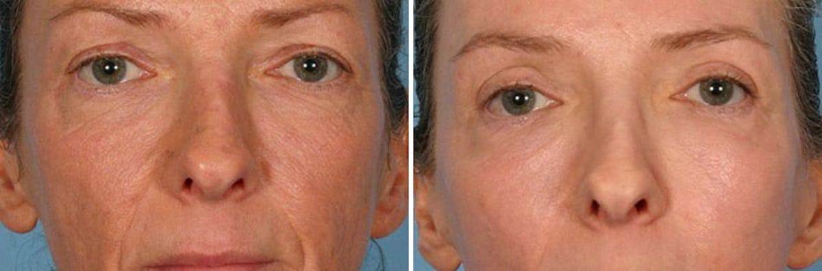 Eyelid Surgery (Blepharoplasty) Before & After Gallery - Patient 376994 - Image 6