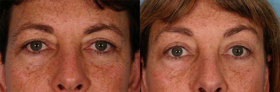 Endoscopic Brow Lift Before & After Gallery - Patient 165157 - Image 3