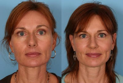 Facial Fat Transfer Before & After Gallery - Patient 704361 - Image 1