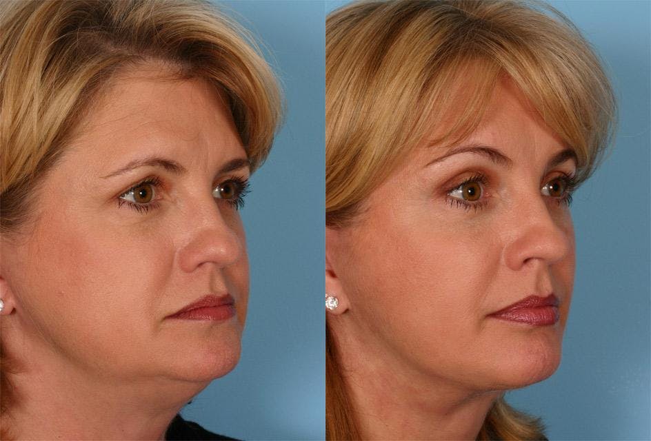 Facelift Before & After Gallery - Patient 264697 - Image 2