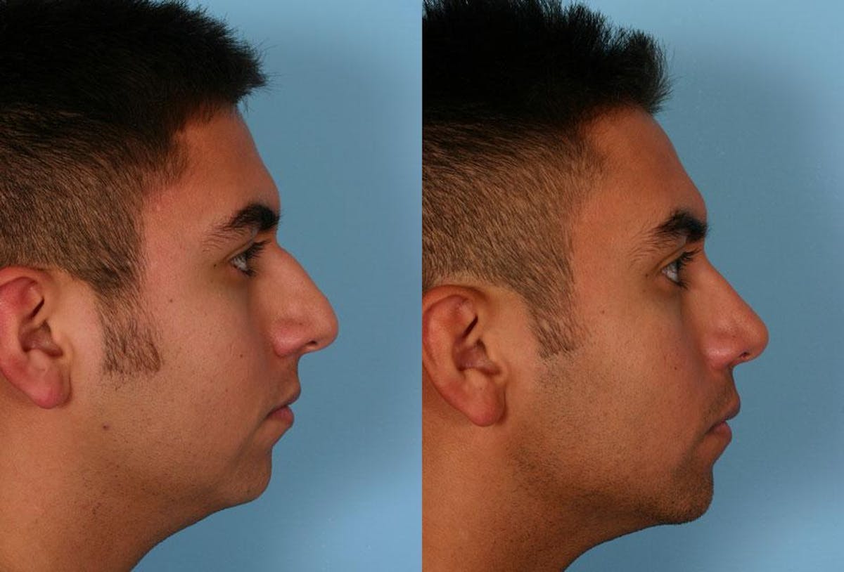 Nasal Obstruction Before & After Gallery - Patient 151758 - Image 2