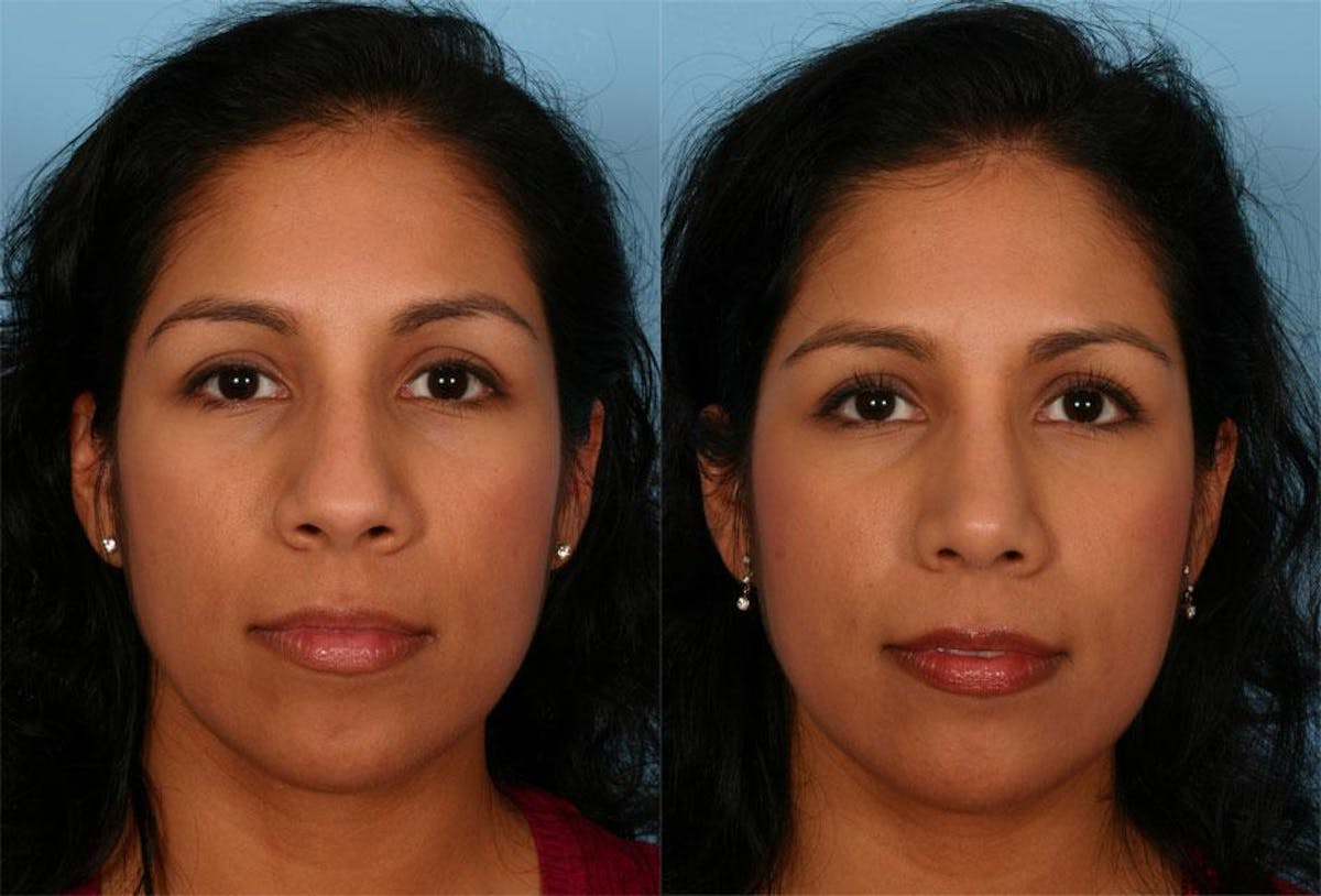 Rhinoplasty Before & After Gallery - Patient 141314 - Image 1